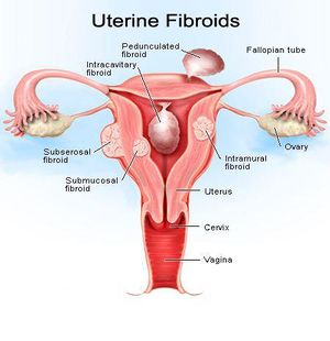 Waspadai Serangan Kanker Serviks
